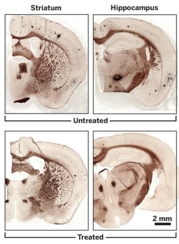 Alzheimer’s Treatments Could Go Acoustic | Chemical